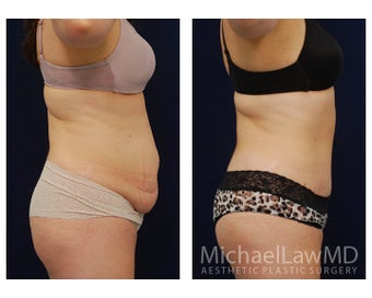 Abdominoplasty - Tummy Tuck 396135