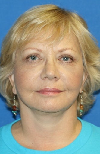 Face Lift after 367591