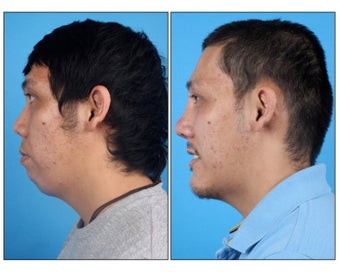 Asian Rhinoplasty and Genioplasty before 331136