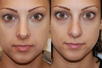 Non-Surgical Rhinoplasty with Silikon-1000 before 93772