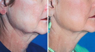 Titan Neck Treatment before 330869