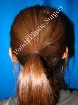 Ear Surgery (Otoplasty) 579104