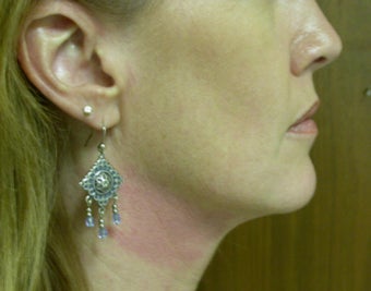 Thermage Treatment after 124645