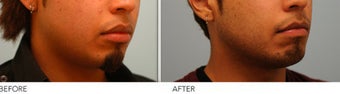 Upper and Lower Lip Reduction after 333433