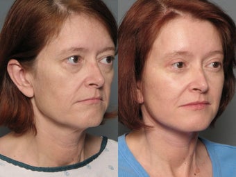 Brow Lift after 338739