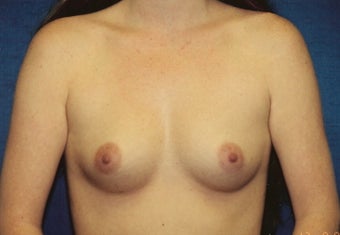 Breast Augmentation before 266782