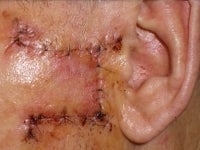 Basal Cell Carcinomas Excisions after 272097