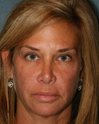 Ultherapy before 499168