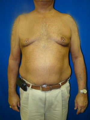Pectus Excavatum, Chest Wall Reconstruction Surgery before 145941