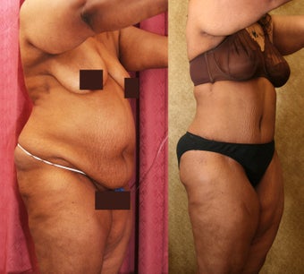 tummy tuck before 304699