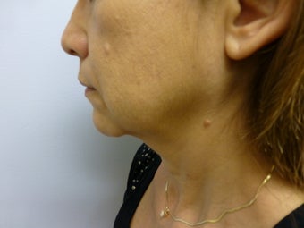 Face and Neck Lift before 625563
