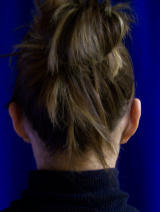 Ear Surgery (otoplasty) after 130067