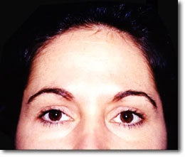 BOTOX after 650563