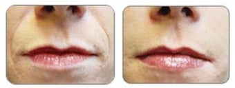 Before and after Restylane around mouth before 6289