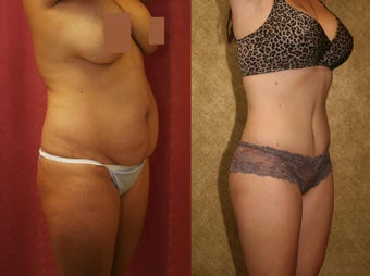 tummy tuck 307970