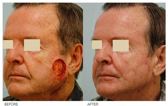 Facial Reconstruction after 136844