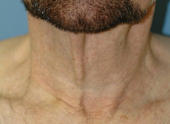 Neck Lift before 537418