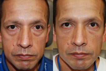 Lower eyelid and cheek rejuvenation with Silikon-1000 before 215265