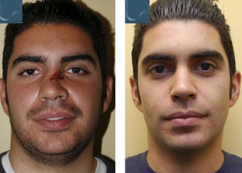 Nasal Reconstruction, Revision Rhinoplasty before 346250