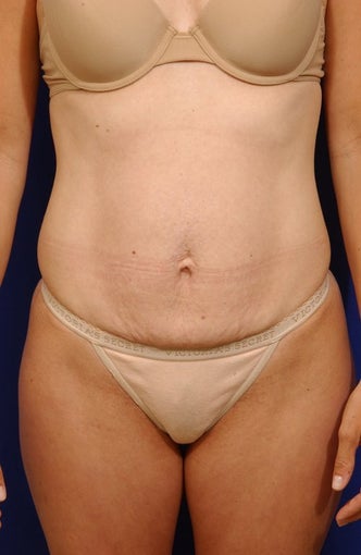 Abdominoplasty with liposculpture of abs and flanks before 82409