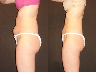 SmartLipo before 96268