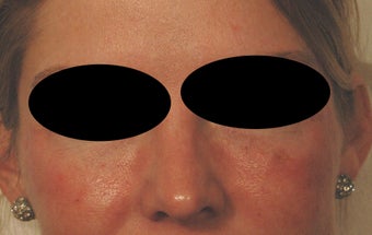 Restylane for Eye Bags after 486784