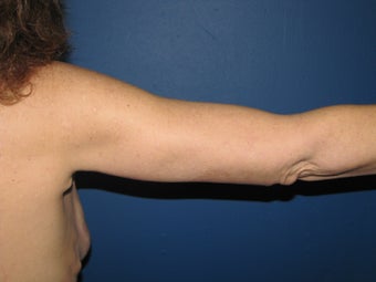 Brachioplasty after 575816