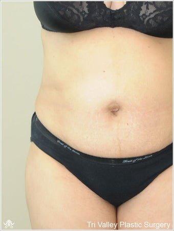 Liposuction after 420931