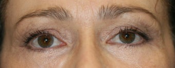 Fraxel Laser after 129994