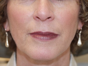 Juvederm after 476833