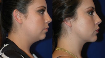 Liposuction of neck with chin implant 388374