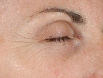 Ulthera Laser Skin Tightening before 346273