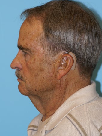 Necklift before 574633