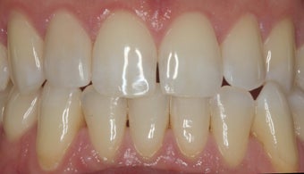 EMAX crown and extreme whitening treatment. after 349670