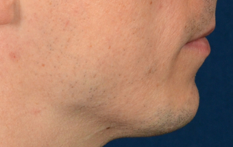 Chin Implant before 555167