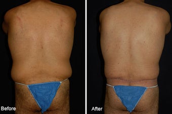 Lower Bodylift before 97745