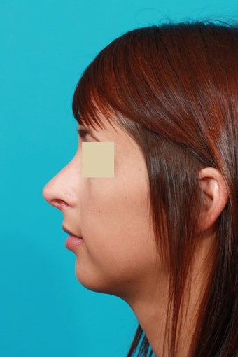 Open Septorhinoplasty after 134620