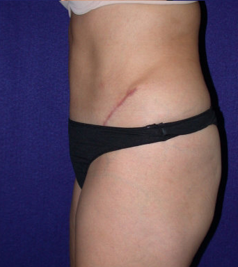 Tummy Tuck (abdominoplasty) 208480