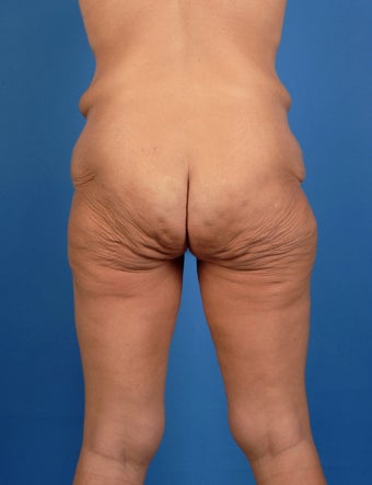 Buttock Lift before 504107