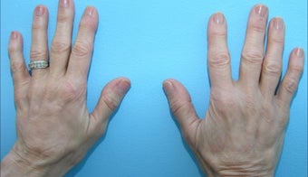 Hand Rejuventation after 590823