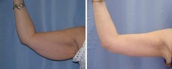 46 years old / brachioplasty (arm lift) before 344020