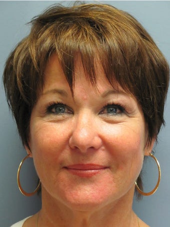 Chin Augmentation before 635125