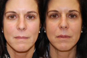 Lip Augmentation with Silikon-1000 before 407821