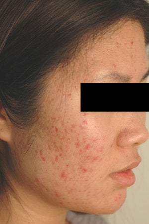 Pulsed Dye Laser Treatment for Red Acne Scars before 104193