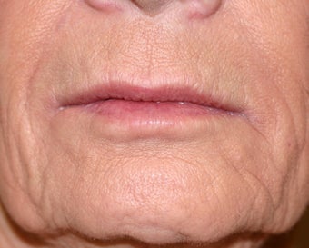 Restylane filler to the lips before 240875
