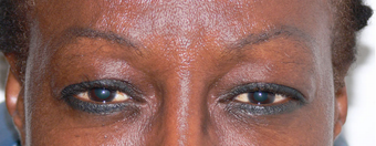 Botox for the frown lines after 490948