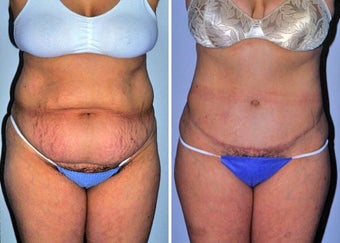 Abdominoplasty (Tummy tuck) before 330697