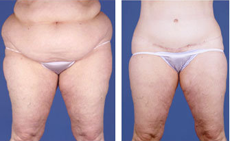 Central body lift with liposuction age 53 before 6817