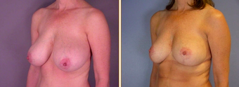 Breast Reduction before 271112