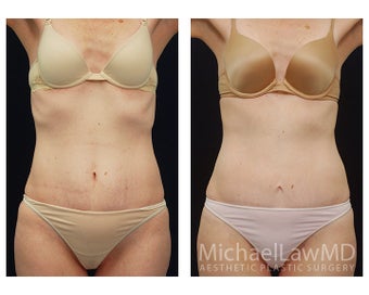 Abdominoplasty - Tummy Tuck before 396013